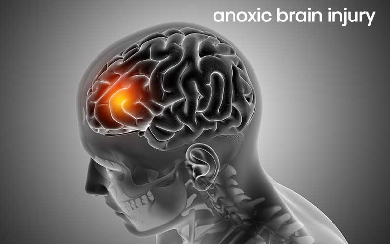 Anoxic Brain Injury