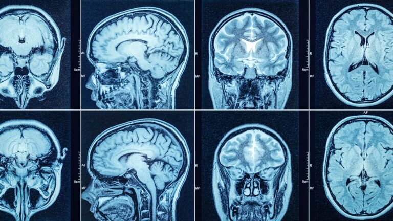 Image of CT Scan of the head and brain