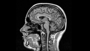 cerebellum fissure MRI