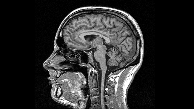 cerebellum fissure MRI