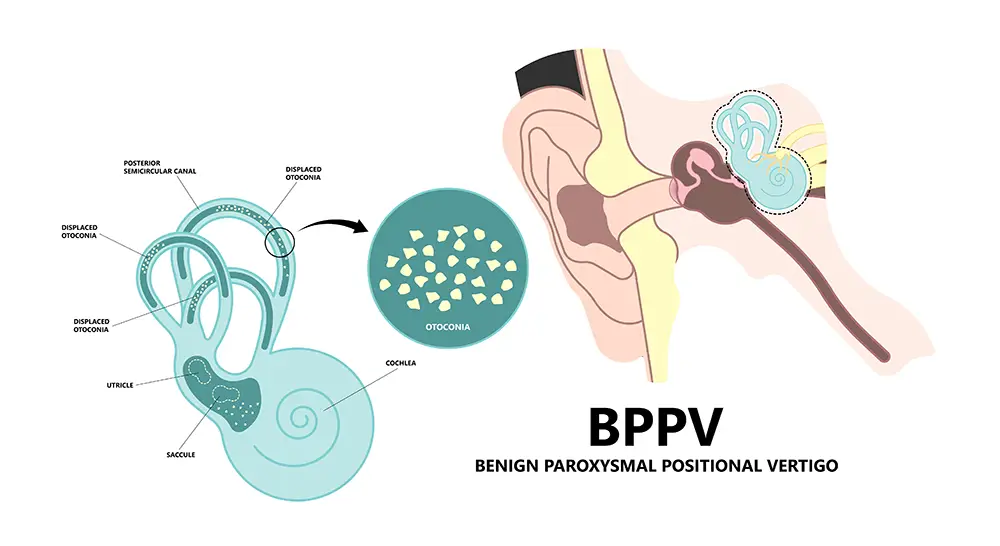 BPPV