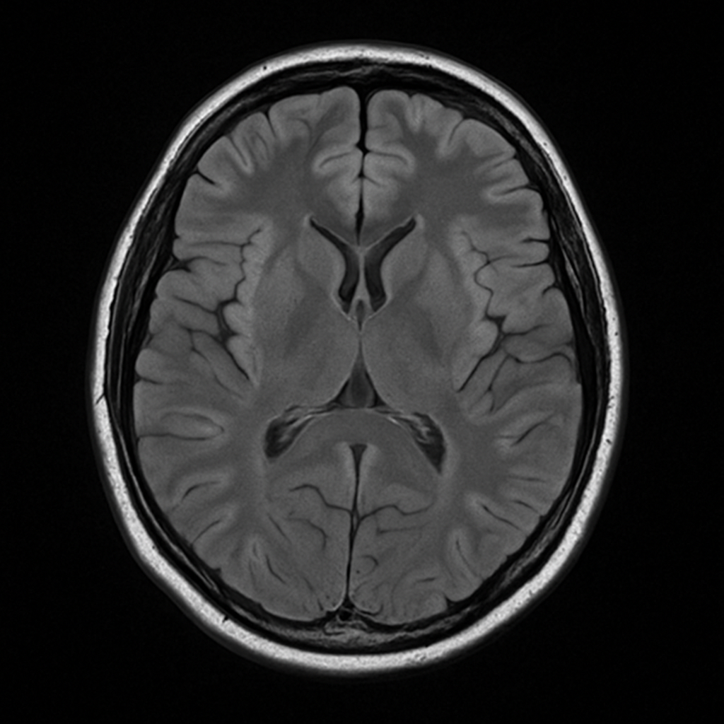 MRI for Concussion