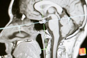 Brain Injury Awareness Facts