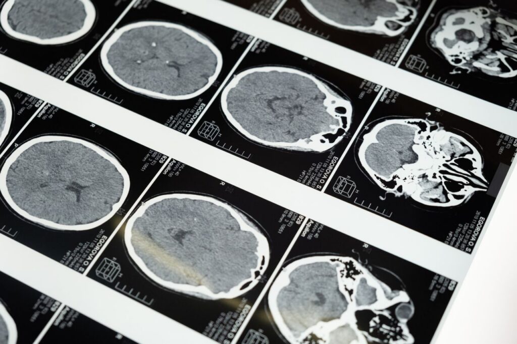 CT scan was normal but I still have symptoms